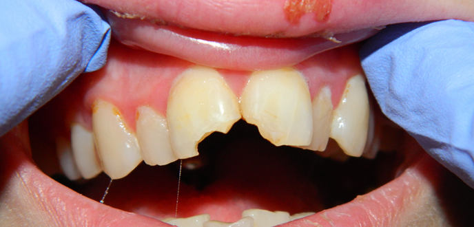 teeth reconstruction before