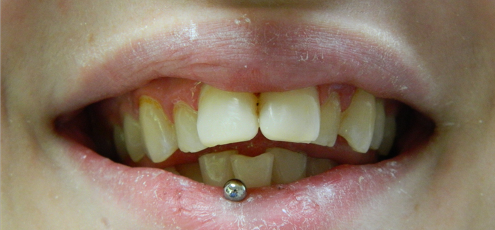 teeth reconstruction after