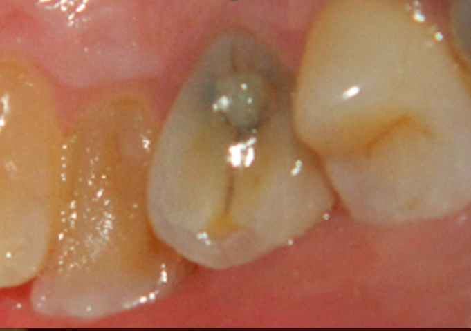 crowns during patient -1