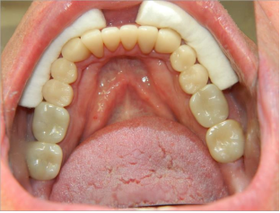 Full mouth reconstruction after - patient 4