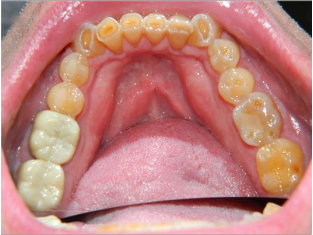 Full mouth reconstruction before - patient 4
