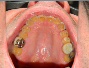Full mouth reconstruction before - patient 3