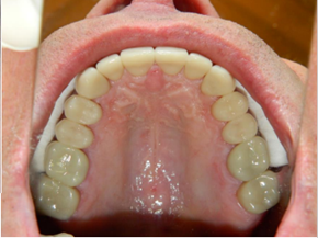 Full mouth reconstruction after- patient 3