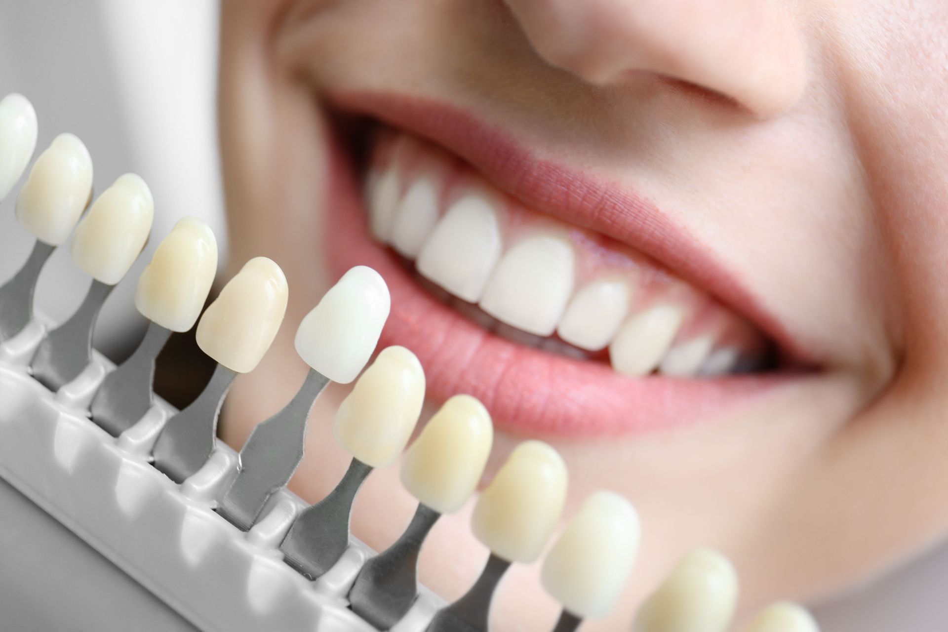 dental teeth whitening services