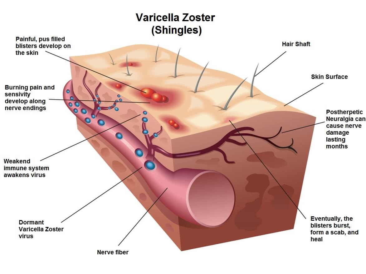 Cross-section of skin showing shingles. Blisters, inflammation, and nerve damage from the Varicella Zoster virus.