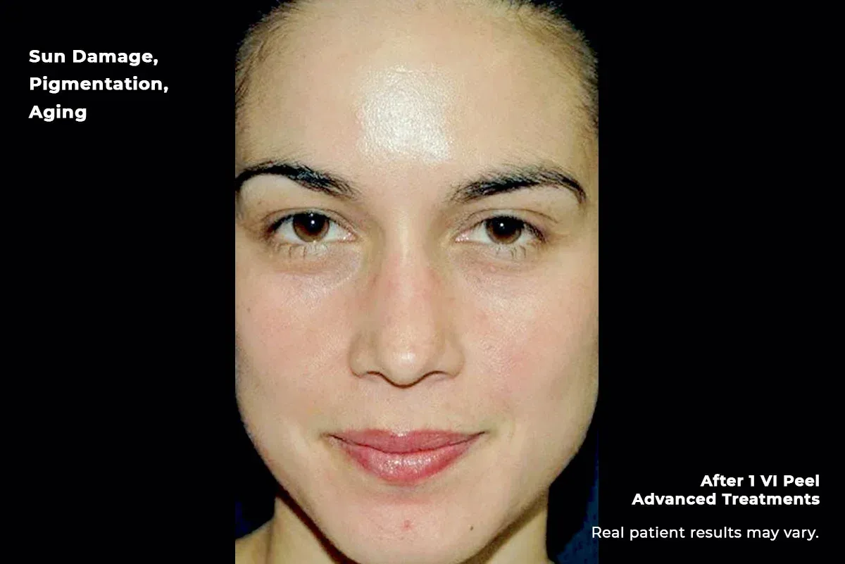 Split-face before-and-after skin treatment: sun damage and pigmentation versus clearer skin after 1 TV peel treatment