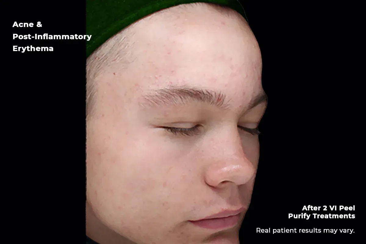 Side-profile face with acne and post-inflammatory erythema after VI Peel treatment