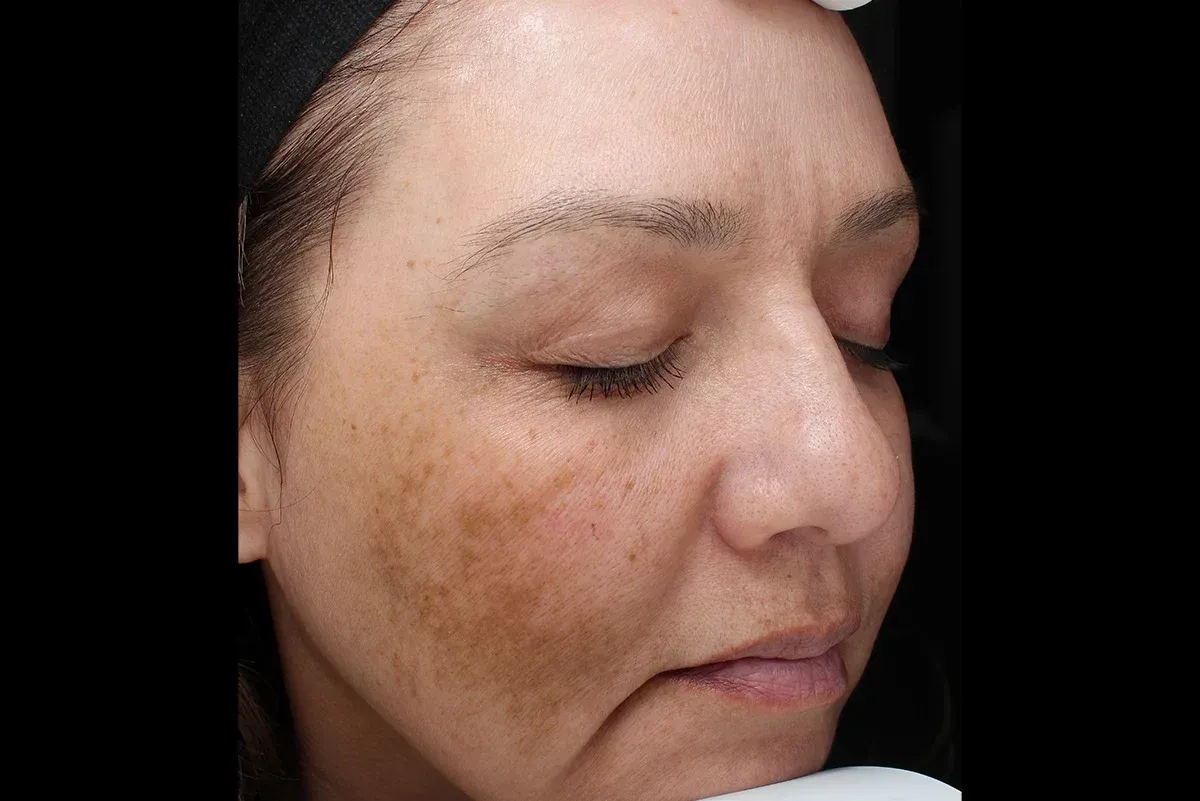 Close-up profile of a woman with eyes closed, showing dark facial pigmentation on her cheeks and forehead.