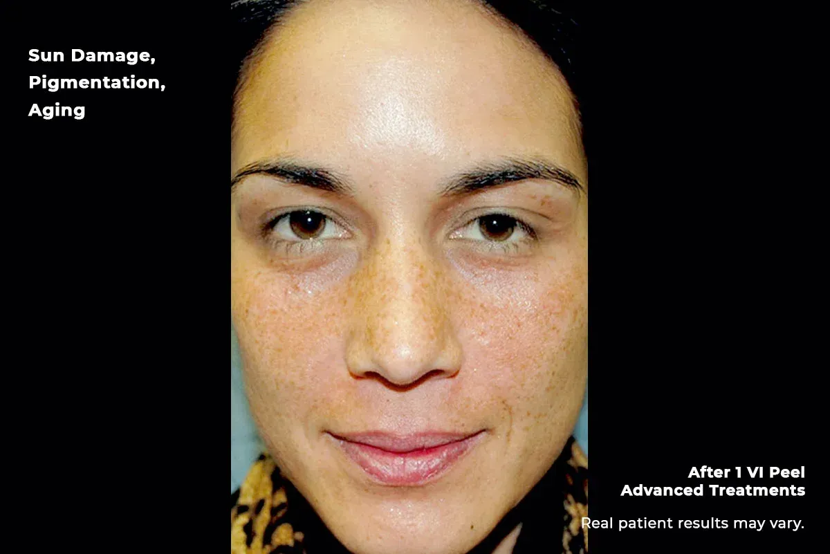 Face with sun damage and pigmentation, shown before and after IPL skin treatment.