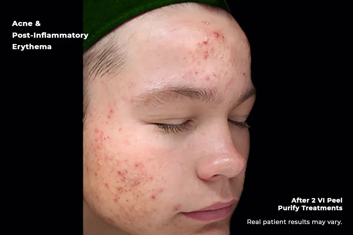Side-profile face with acne and post-inflammatory erythema on cheek and forehead; before-and-after V Peel treatment