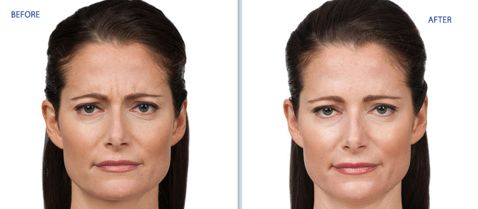 Before-and-after face comparison showing reduced forehead lines and smoother skin on the right
