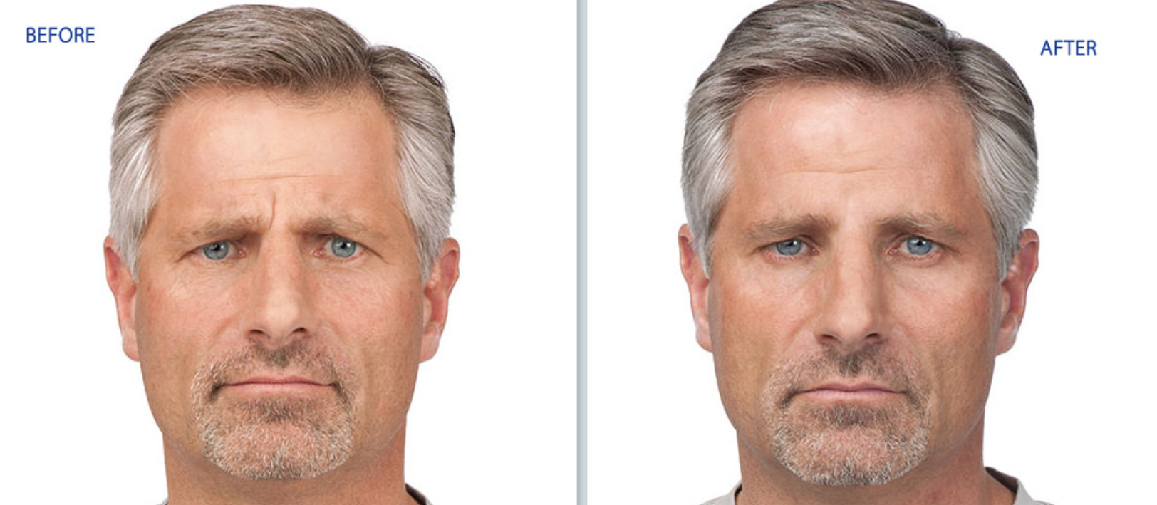 Before-and-after headshots of a man with more defined eyebrows and facial contrast, side by side