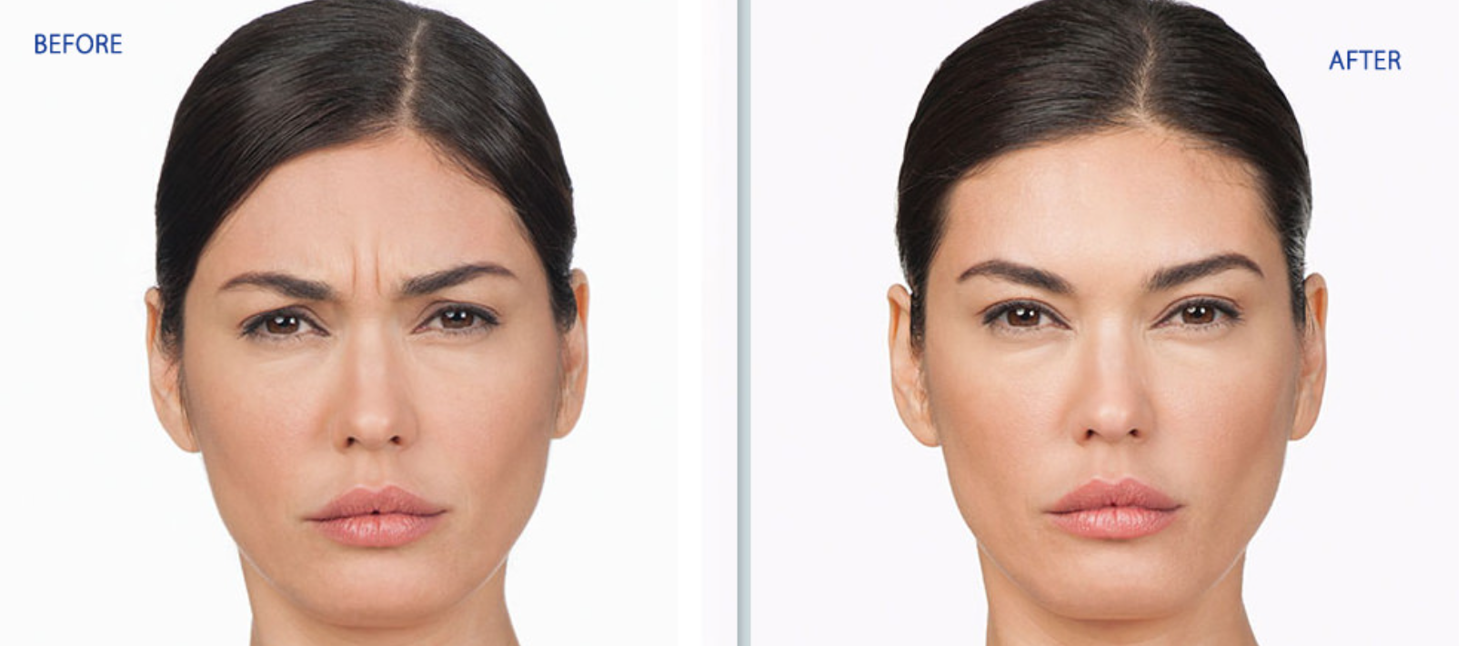 Before-and-after face comparison showing reduced forehead wrinkles and smoother skin.