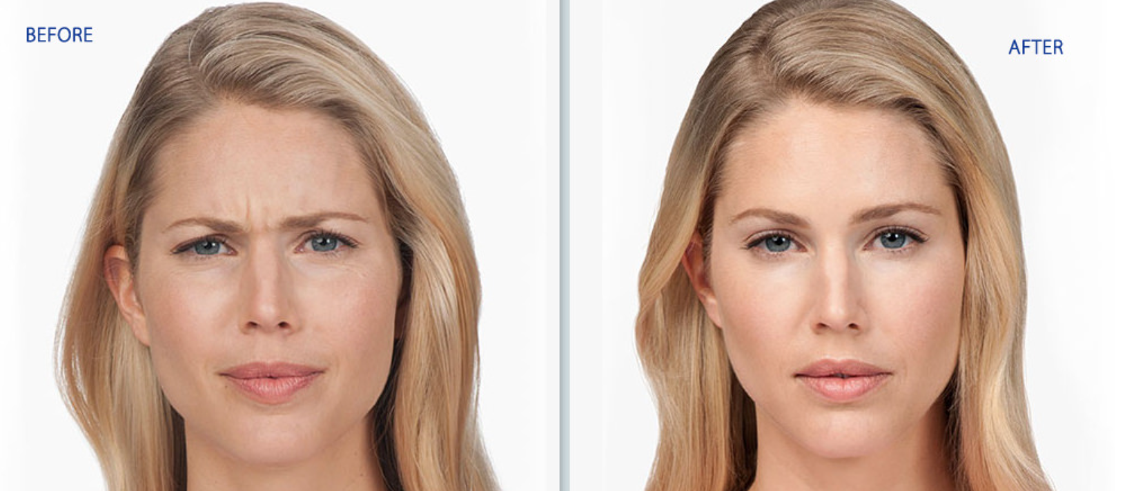 Before-and-after comparison of a woman's face, showing smoother skin on the right.