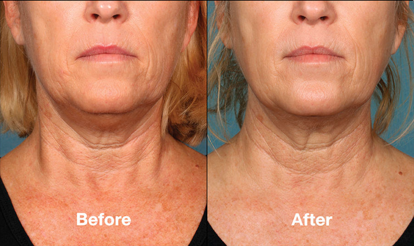 Side-by-side “Before” and “After” close-ups of a neck, showing smoother skin and reduced wrinkles.