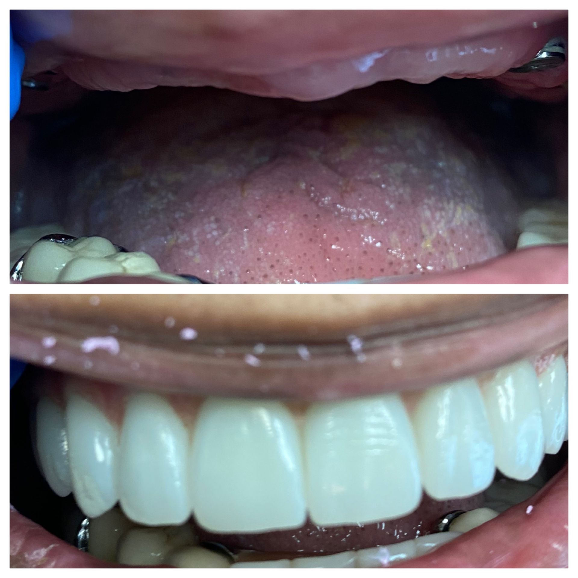 Mouth close-up showing tongue and a row of white teeth in bright light