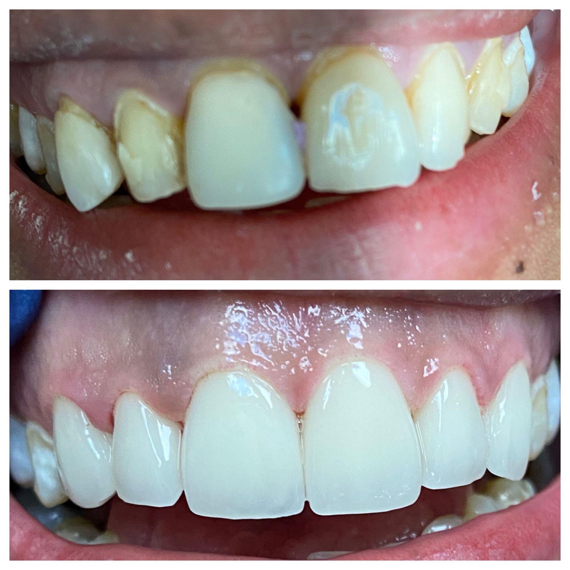 Teeth before and after whitening: yellowed teeth above, brighter white teeth below.