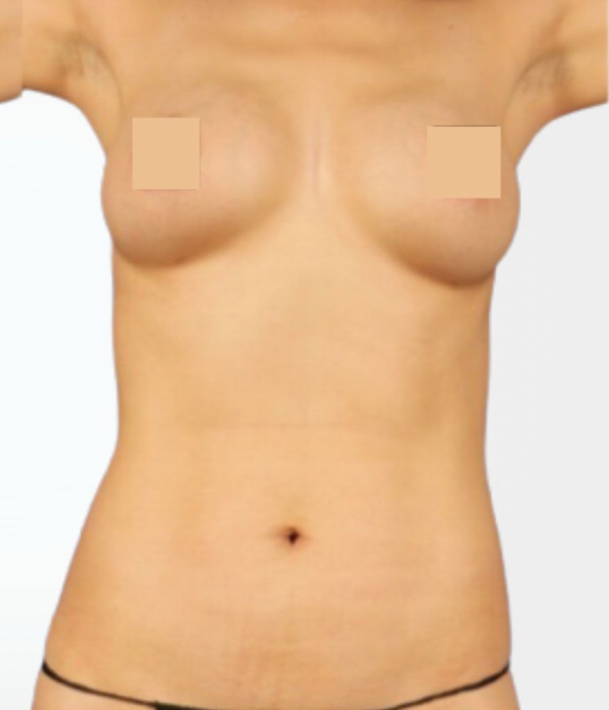 Breast Lift - after