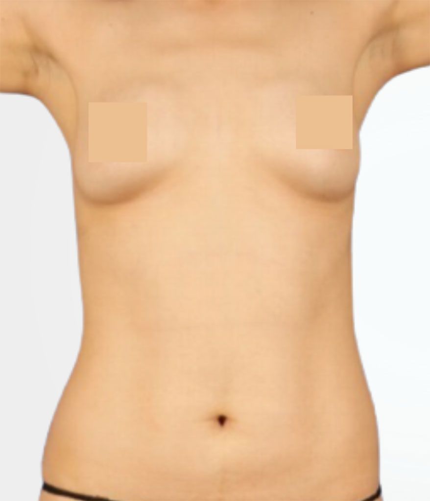 Breast Lift - before