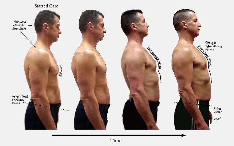 Image of a man before and after chiropractic care