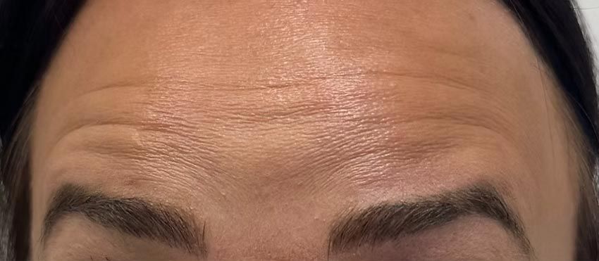 A close up of a woman 's forehead with wrinkles and eyebrows.