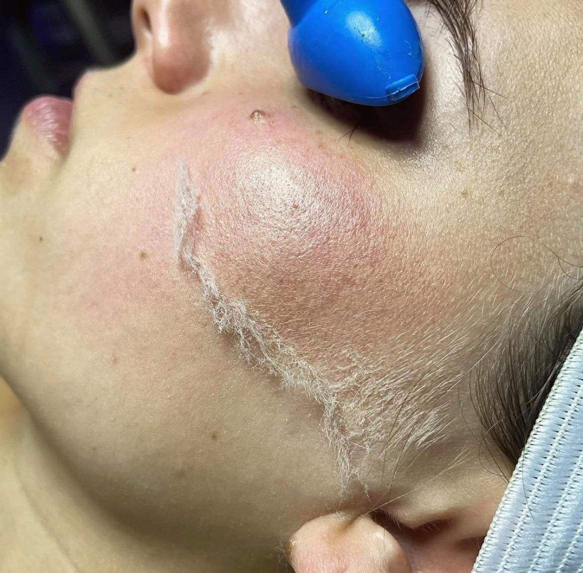 A close up of a woman 's face with a blue object on it.