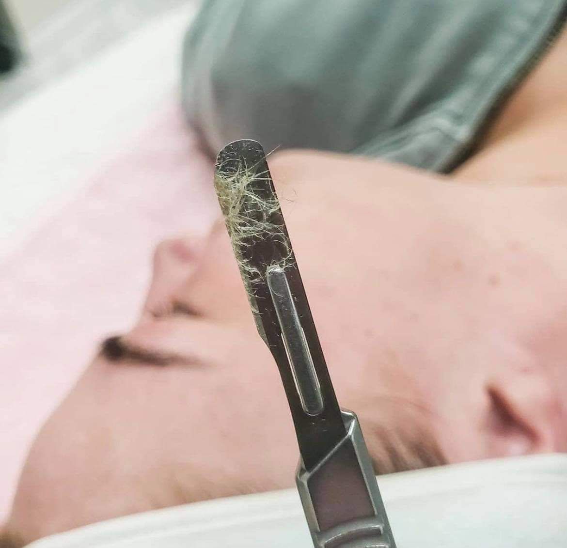 Dermaplaning service