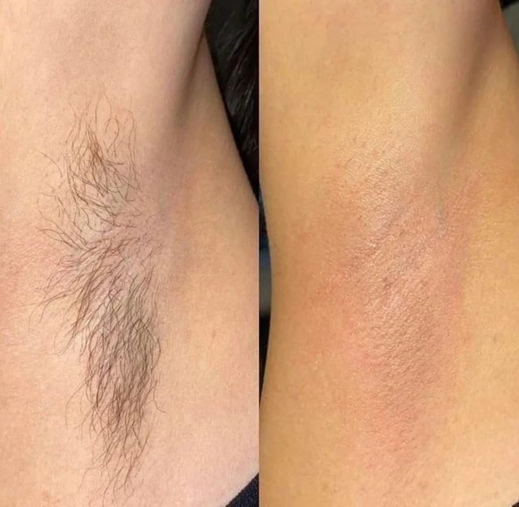 A before and after picture of a woman 's underarm.