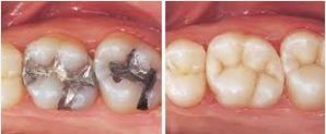Dental Fillings