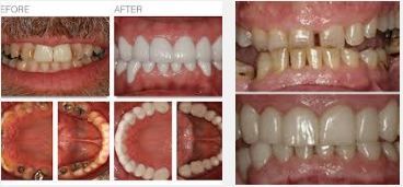 Full mouth reconstruction