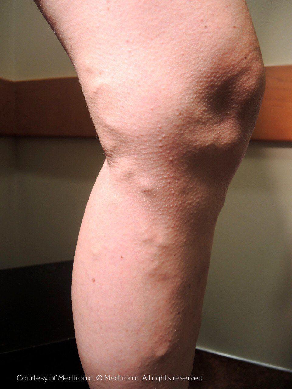 A close up of a person 's leg with veins on it