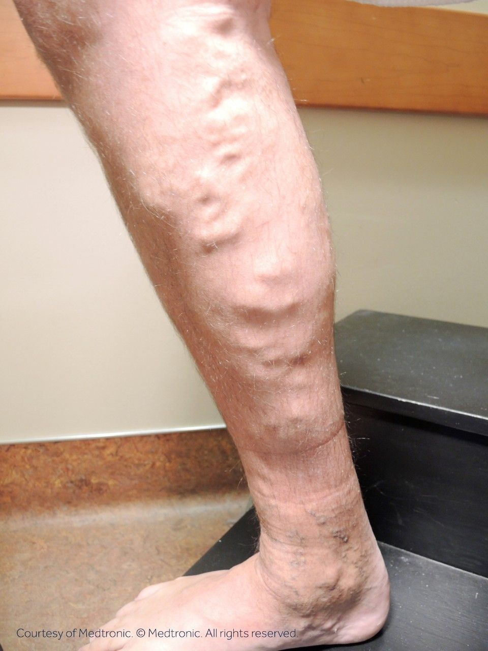 A close up of a person 's leg with varicose veins