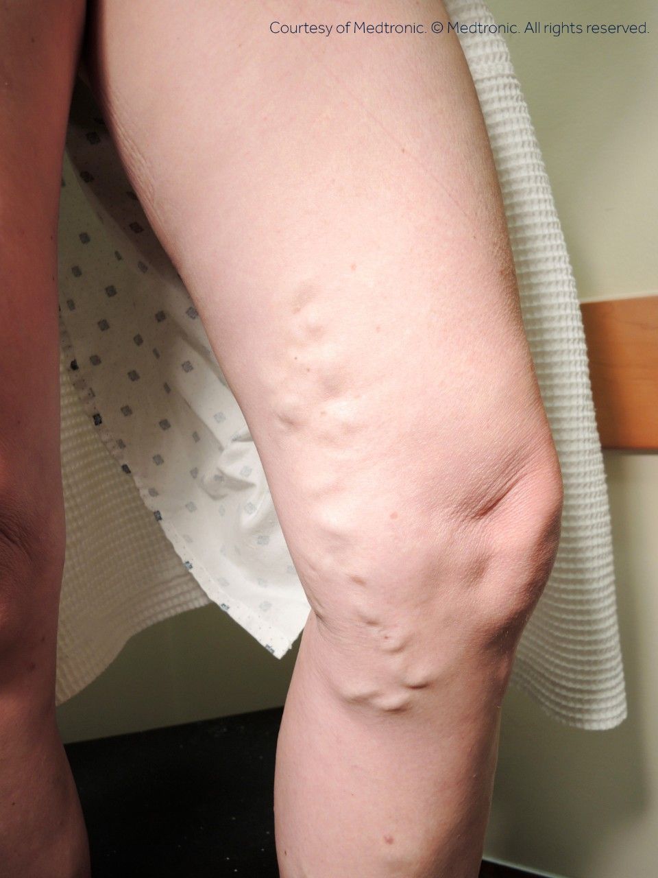 A close up of a woman 's leg with varicose veins