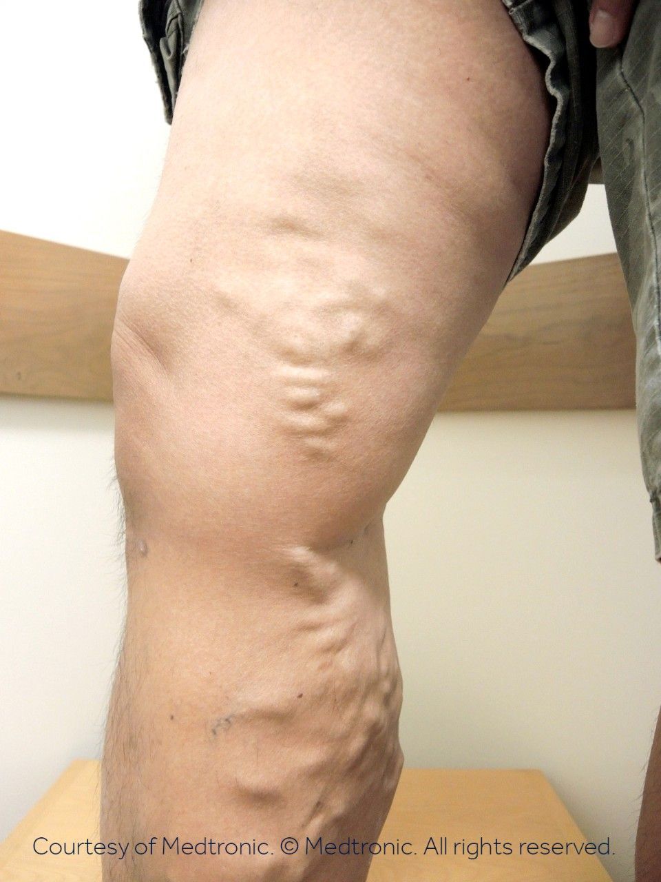 A close up of a person 's leg with varicose veins