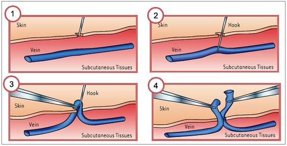 A diagram of a vein being opened with a needle