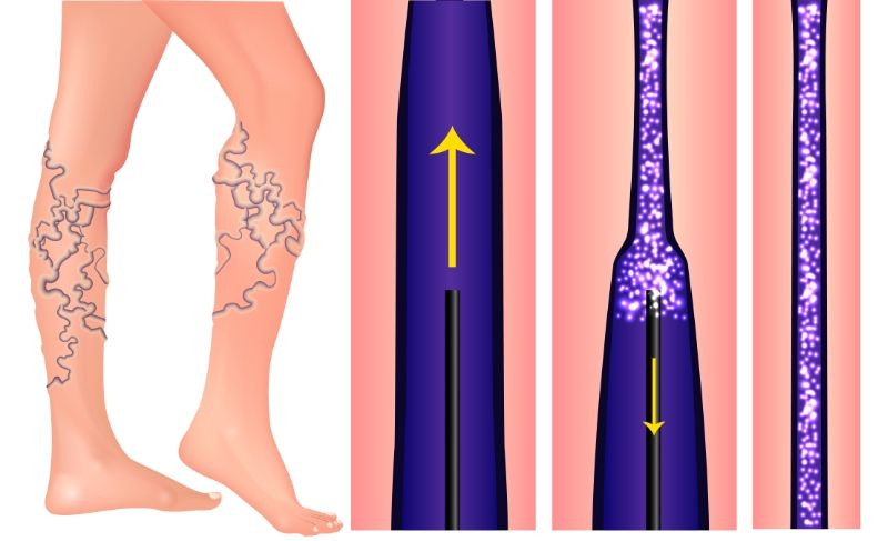 A woman 's legs with varicose veins and an arrow pointing up.