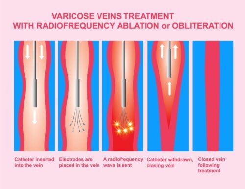 A diagram of varicose veins treatment with radiofrequency ablation or obliteration.