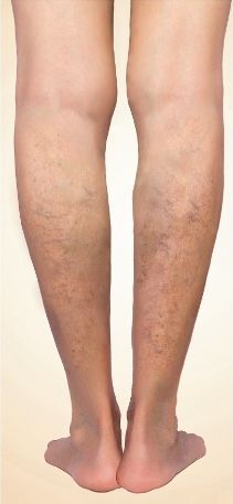 A close up of a person 's legs with varicose veins.