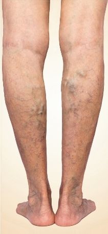 A close up of a person 's legs with varicose veins.