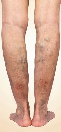 A close up of a person 's legs with varicose veins.
