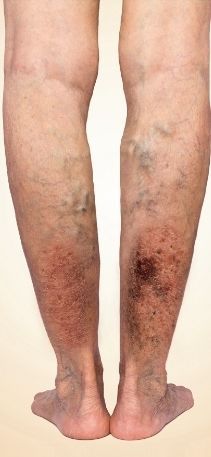 A close up of a person 's legs with varicose veins.