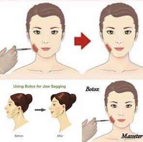 Before-and-after diagrams showing jaw slimming, with injection point and labeled masseter muscle.