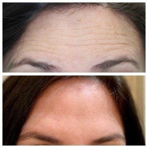 Forehead before and after treatment, showing fewer wrinkles and smoother skin