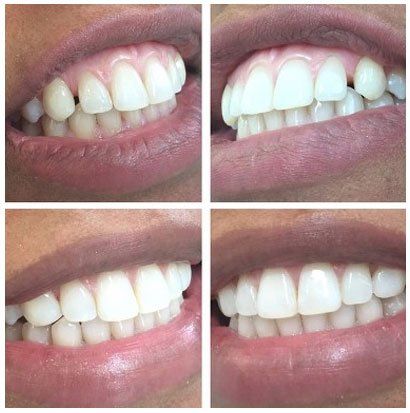 Dental works before and after