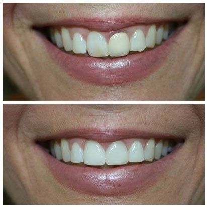 Dental works before and after