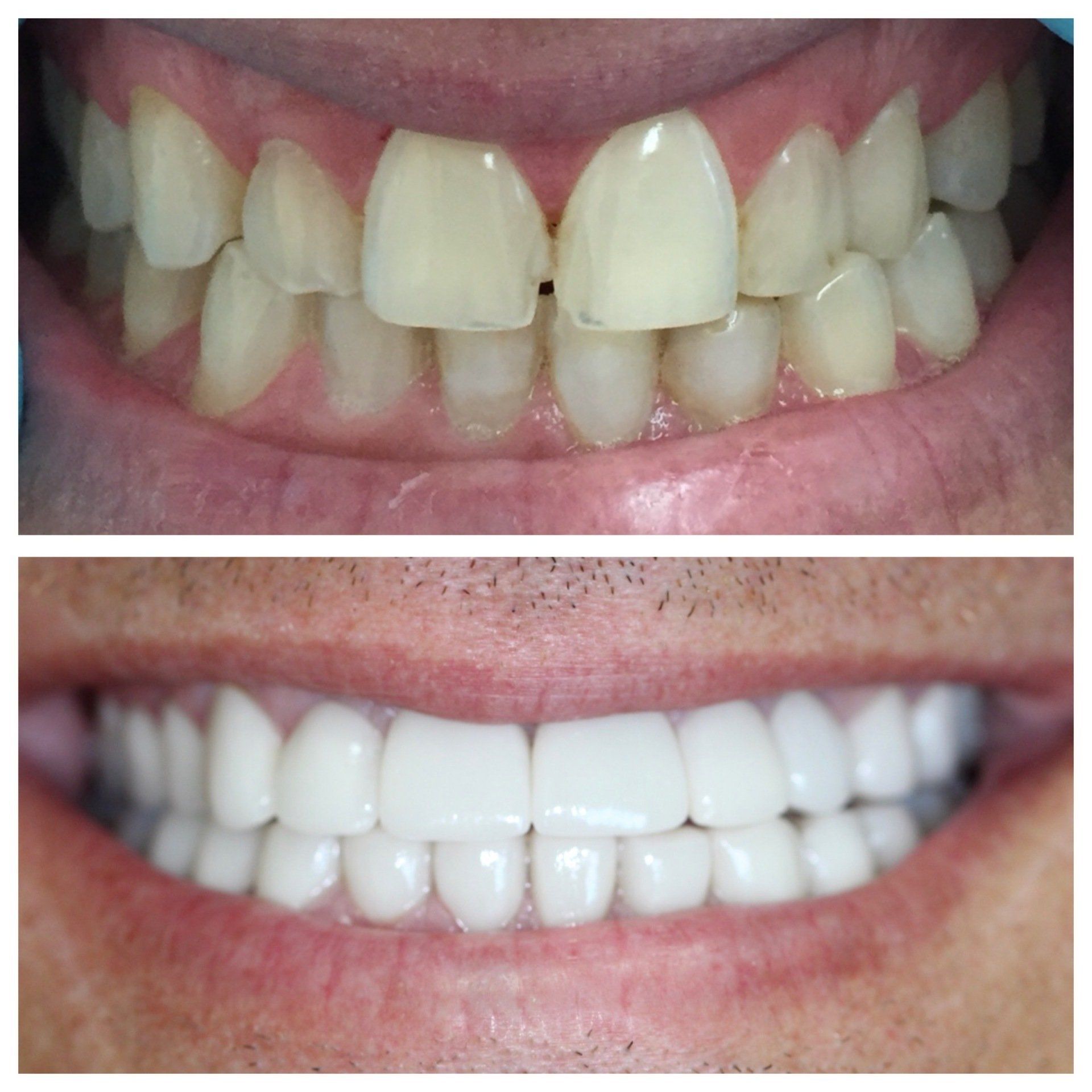Dental works before and after
