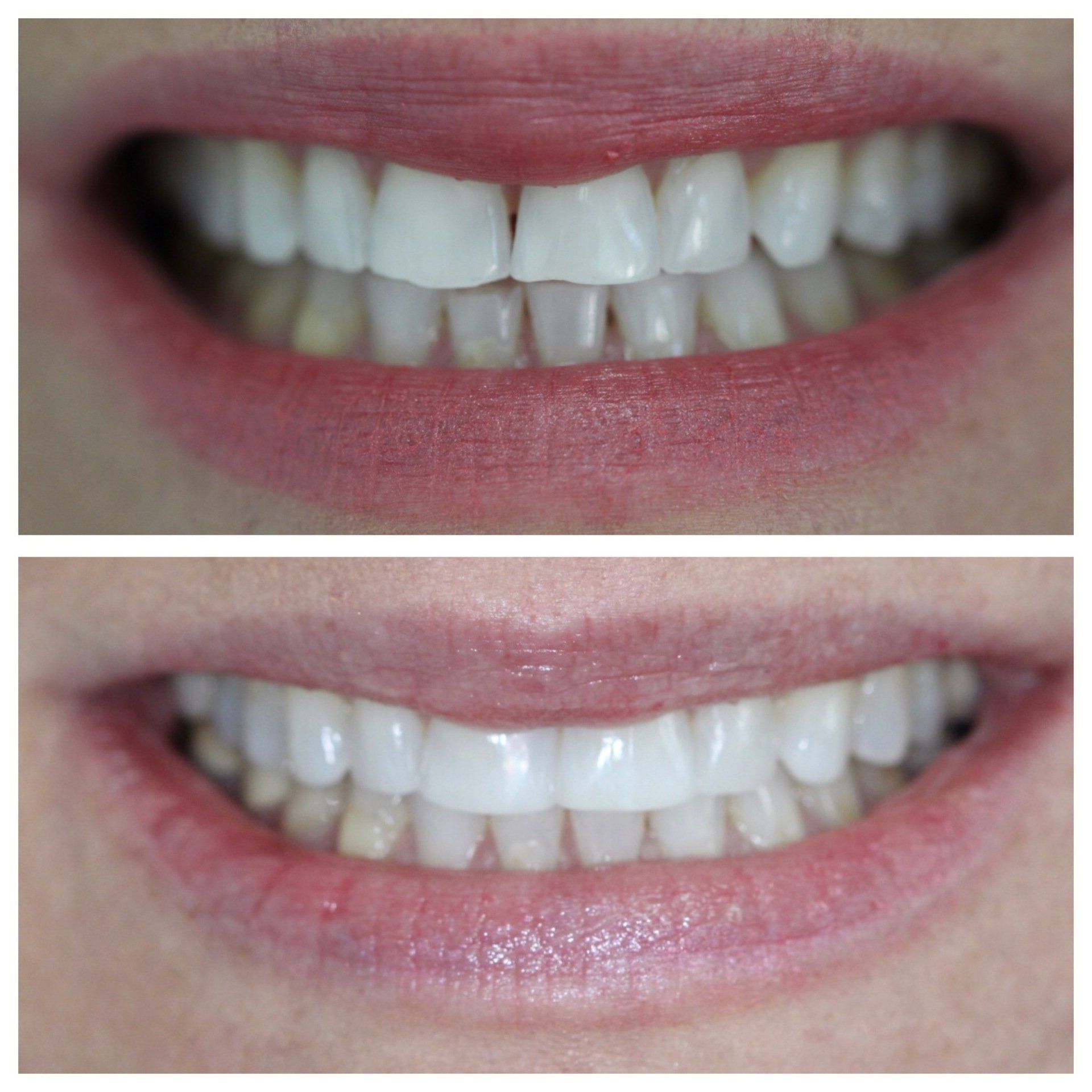 Dental works before and after