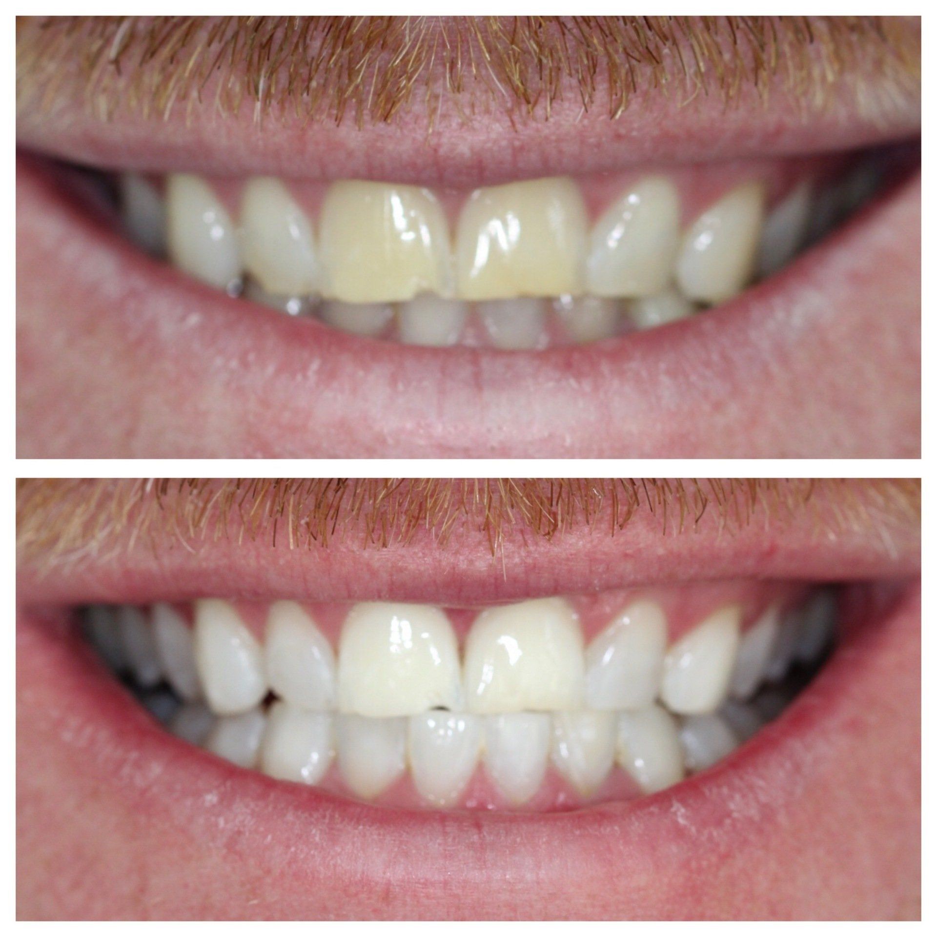 Dental works before and after
