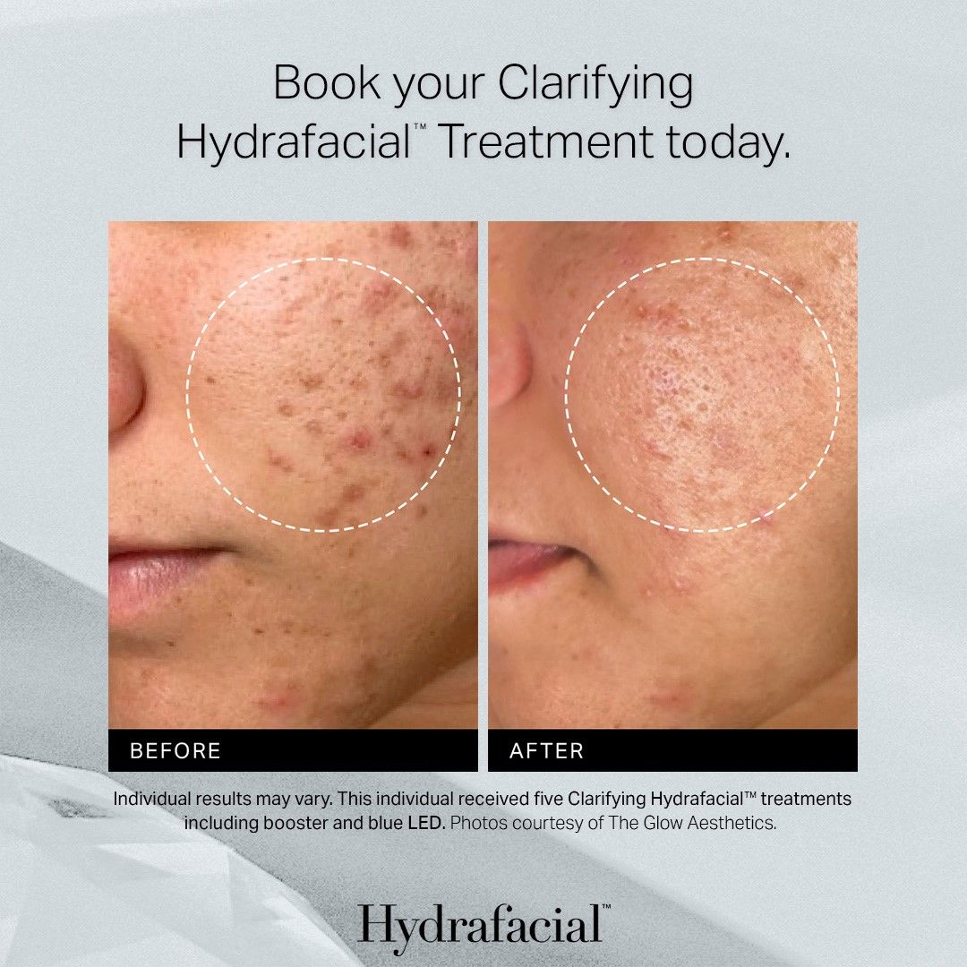 Hydrafacial treatment before and after