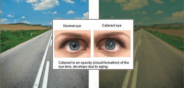 Cataract Condition